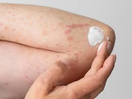 Fungal Infection Doctor in Buldhana