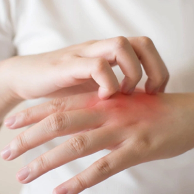 Fungal Infection Doctor in Durg