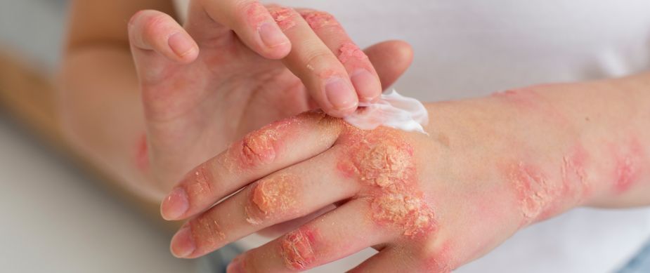 Fungal Infection Doctor in Wardha