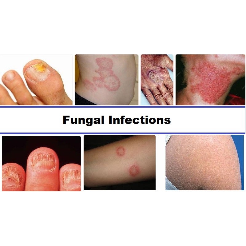 Fungal Infection Doctor in Ambikapur – Dr. Ayesha Faizan