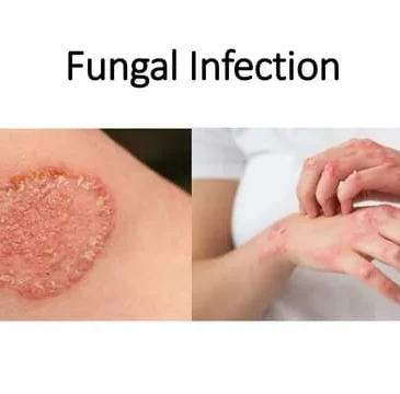 Fungal Infection Doctor In Washim