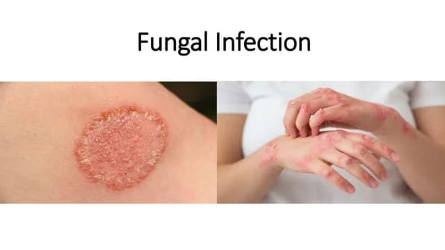 Fungal Infection Doctor In Washim