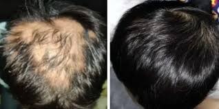 Hair Loss Doctor in Amravati