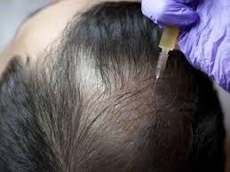 Hair Loss Doctor in Betul