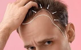 Hair Transplant in Buldhana