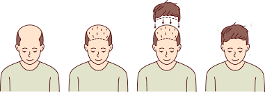 Hair Transplant in Chhindwara