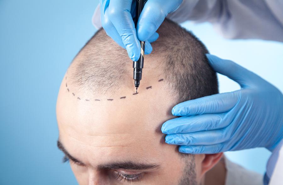Hair Transplant in Durg