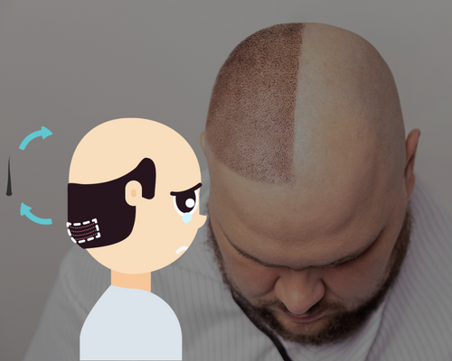 Hair Transplant in Gondia