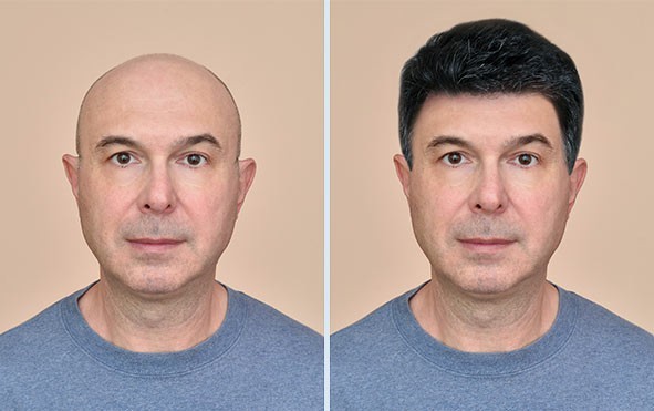 Hair Transplant in Wardha