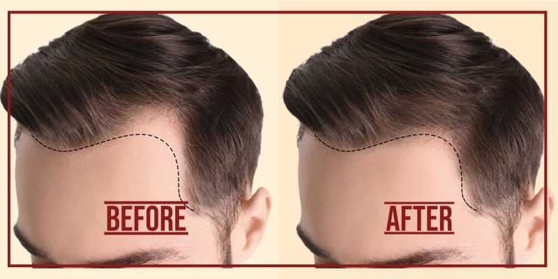 Hair Transplant in Adilabad