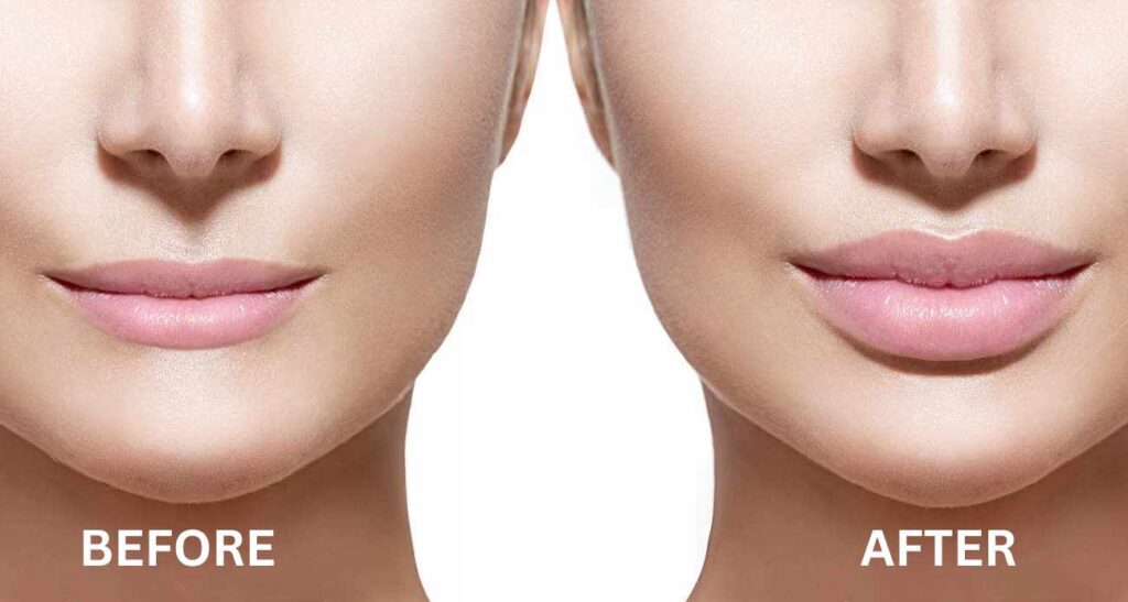 Lip Filler Clinic In Nagpur