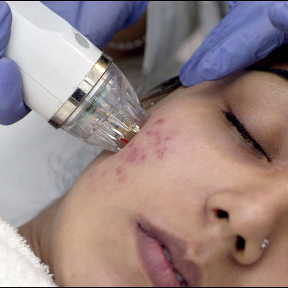 MNRF Treatment in nagpur