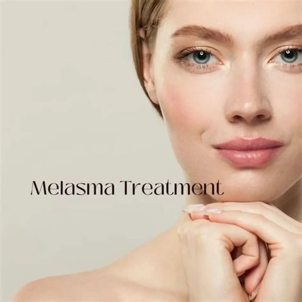 Melasma treatment in nagpur