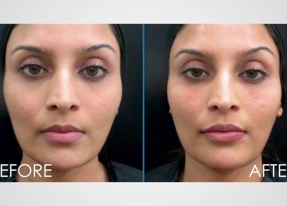 Non-Surgical-Facelift-in Nagpur