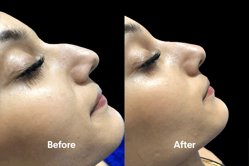 Nose reshaping Without Surgery In Nagpur