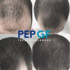 PEP-GF Treatment in nagpur