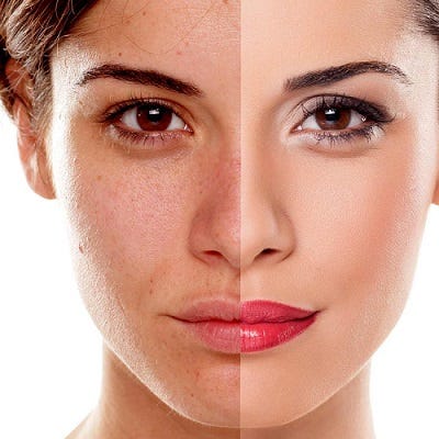 Pigmentation Treatment In Jabalpur