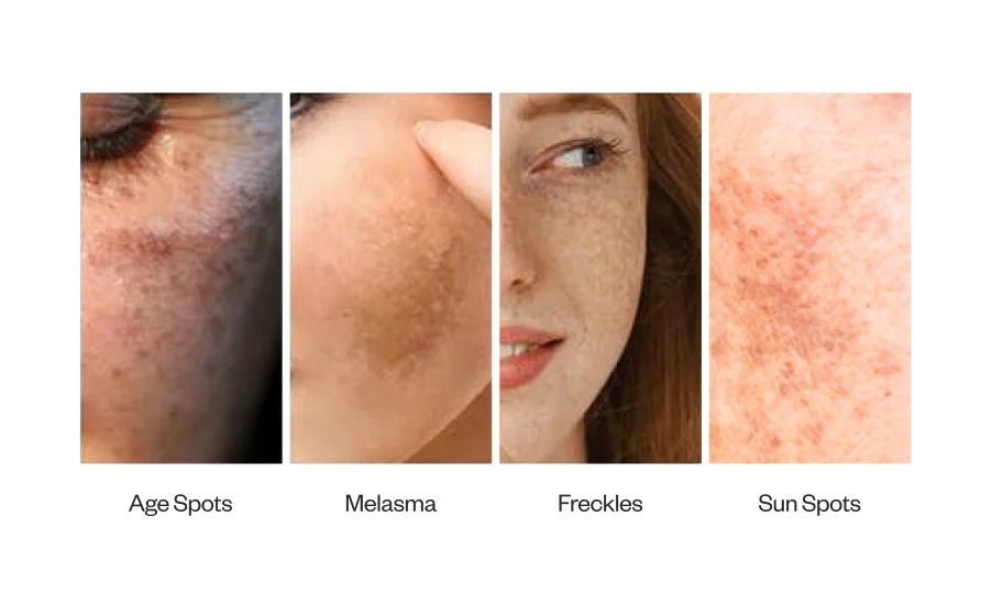 Pigmentation Treatment in Betul – Dr. Ayesha Faizan