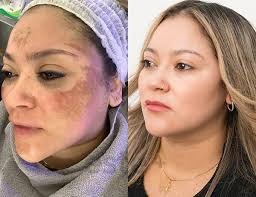 Pigmentation Treatment in Buldhana