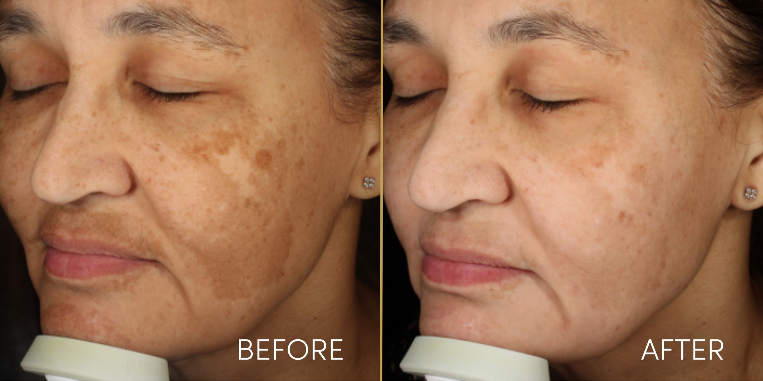 Pigmentation Treatment in Seoni