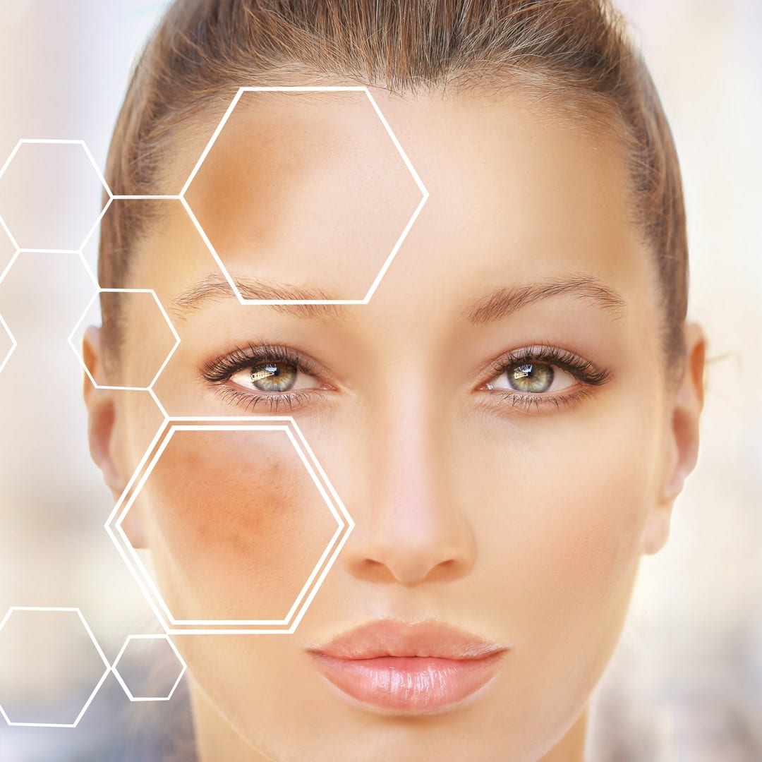 Pigmentation Treatment in Chandrapur