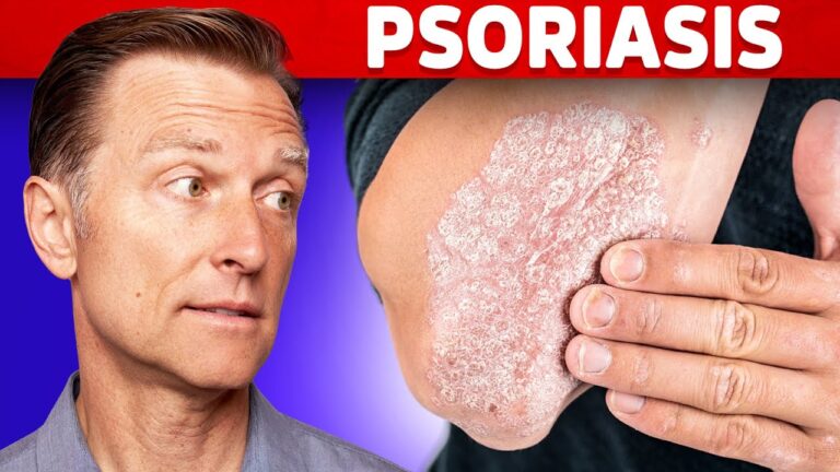 Psoriasis Treatment in nagpur