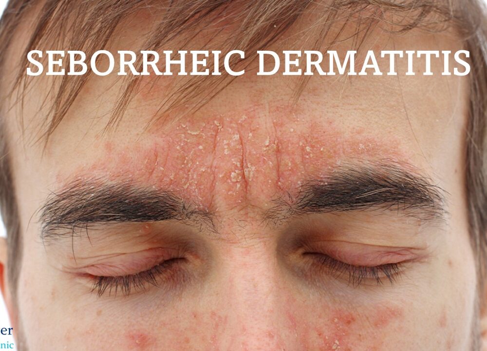 Fungal Infection Doctor in Betul – Dr. Ayesha Faizan