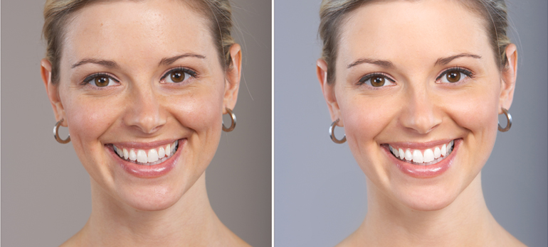 Skin Whitening Treatment in Durg