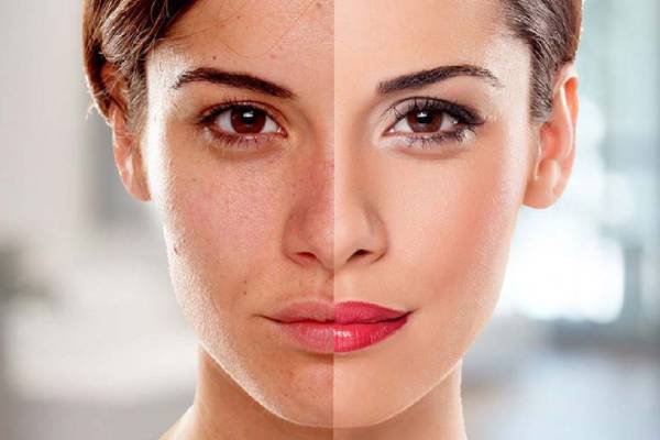 Skin Whitening Treatment In Wardha