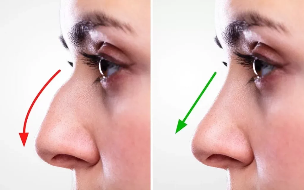 Straightening nose without Surgery In Nagpur