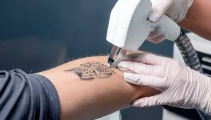 Tattoo Removal in Betul – Dr. Ayesha Faizan