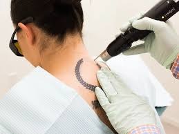 Tattoo Removal in Amravati