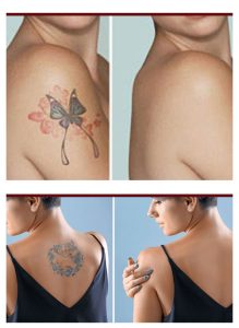 Best Tattoo Removal in Adilabad