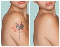 Best Tattoo Removal in Gadchiroli