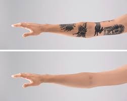Tattoo Removal in Rewa –