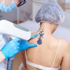 Tattoo Removal in Yavatmal