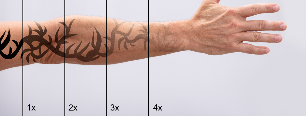 Tattoo Removal in Bhilai – Dr. Ayesha Faizan