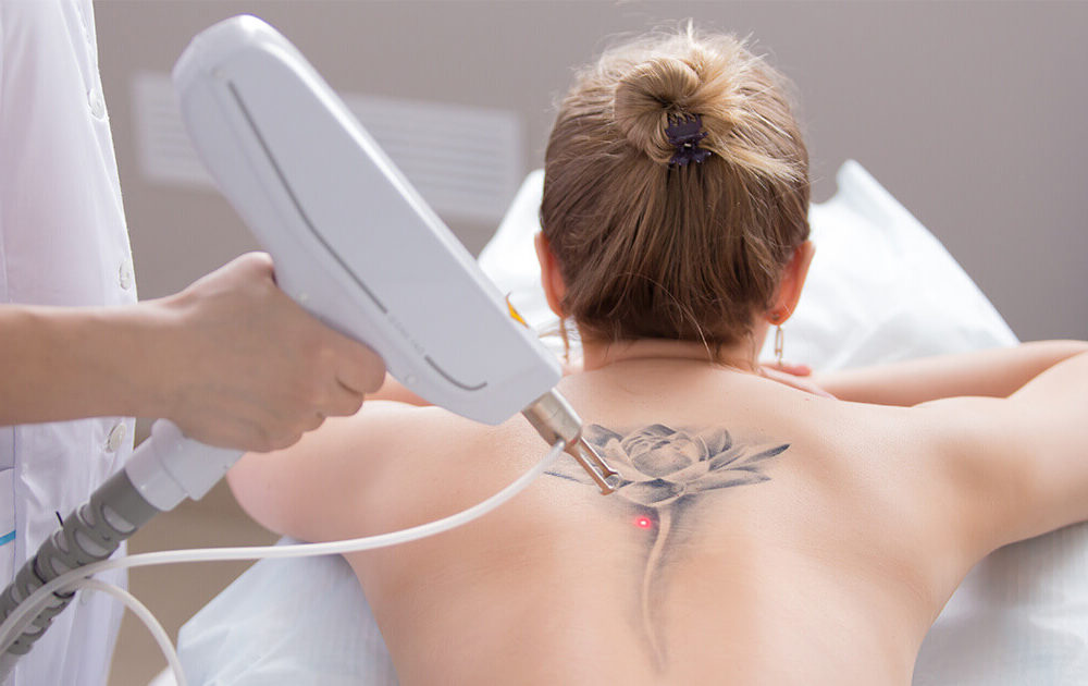 Tattoo removal in nagpur