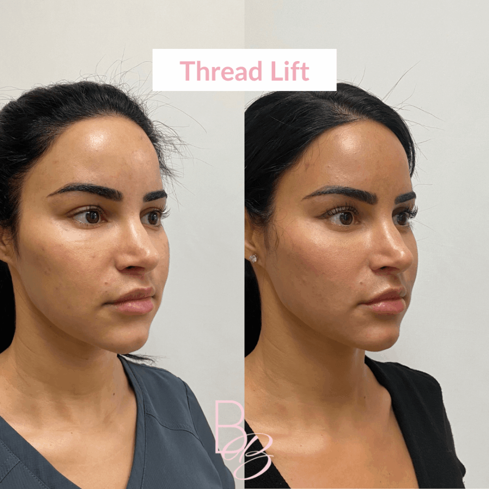 Threadlift treatment in nagpur