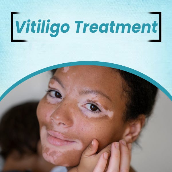 Vitiligo Treatment in nagpur