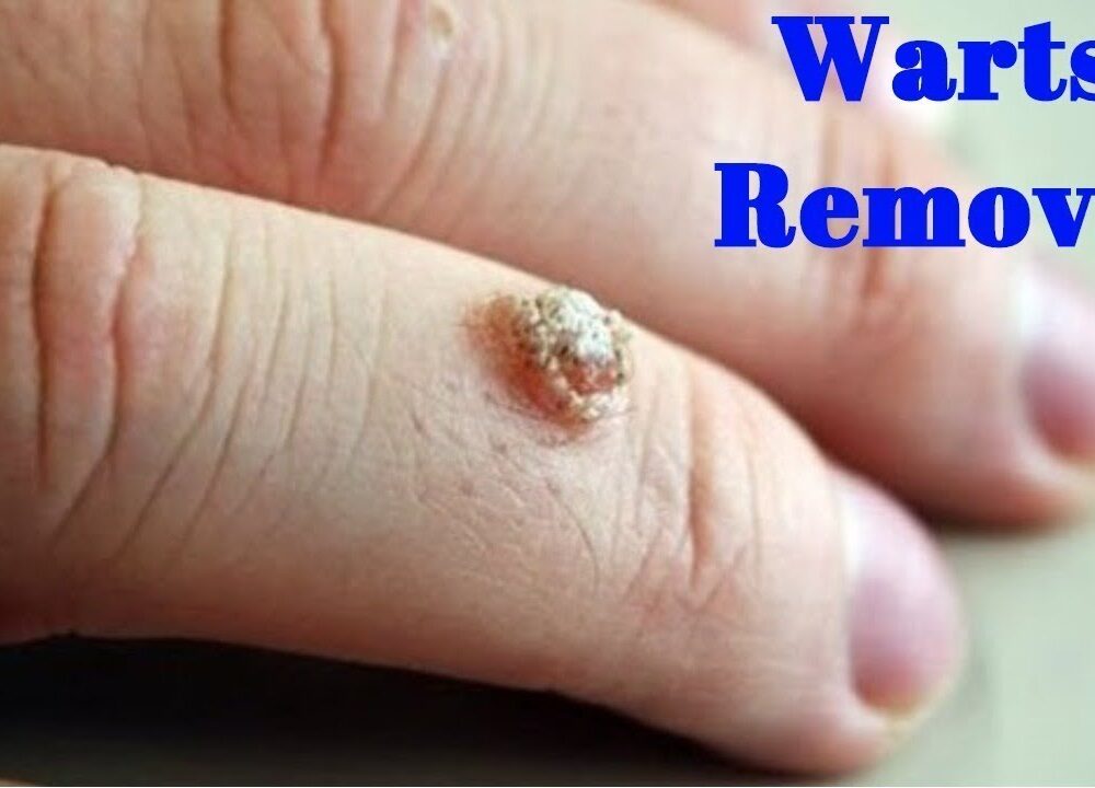 Wart removal in nagpur