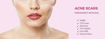 Best Acne Scar Treatment in Chhindwara