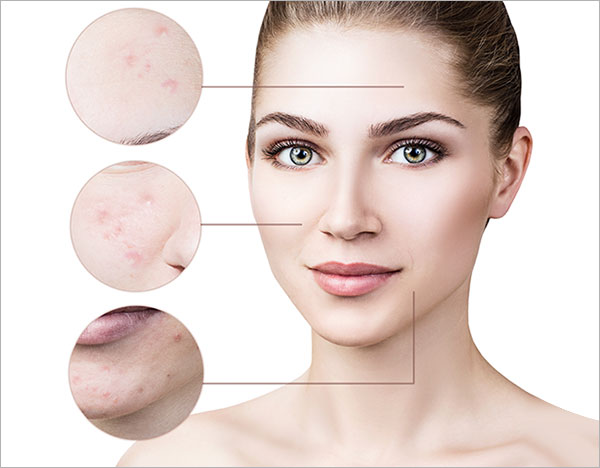 Best Acne Scar Treatment in Chandrapur