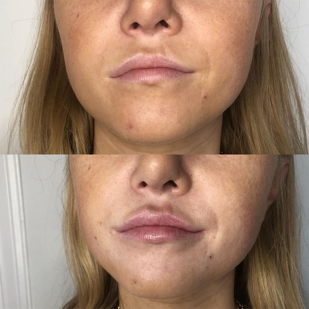 FIllers For Scars