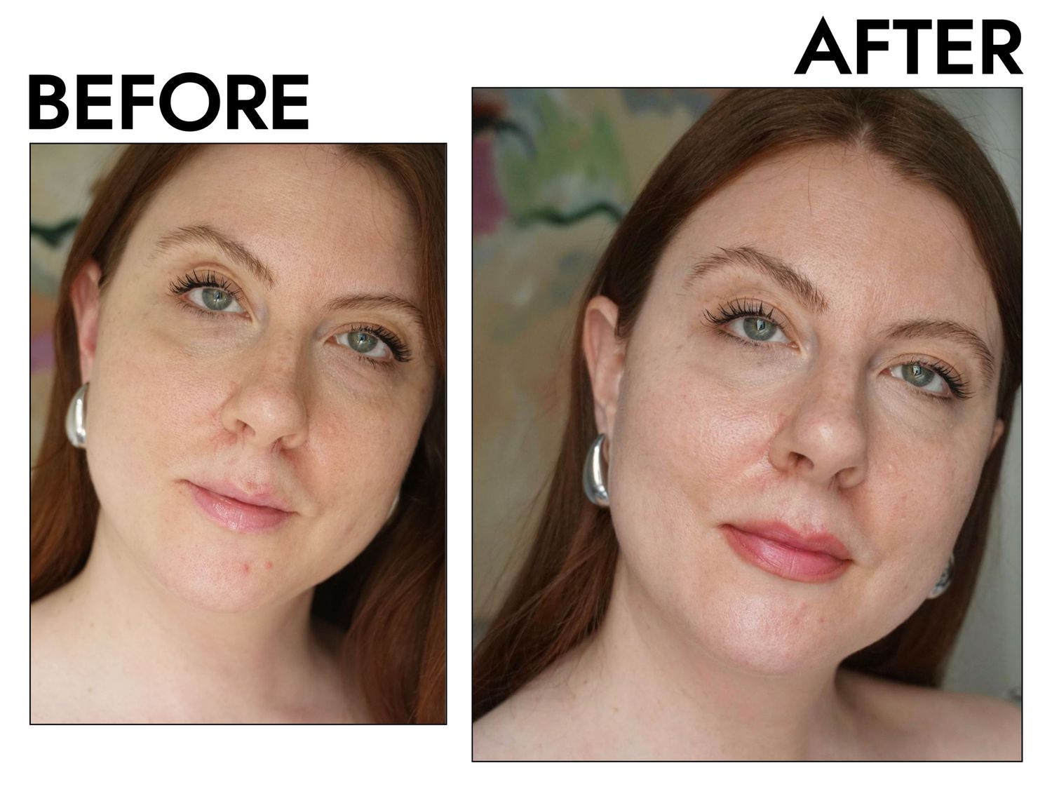 Glowpulse IPL Treatment