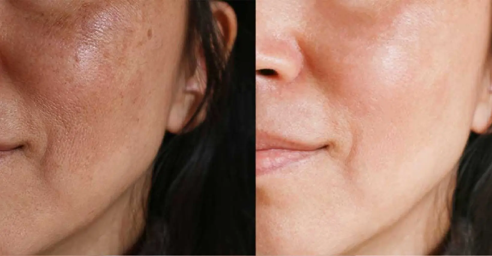 Melasma Removal