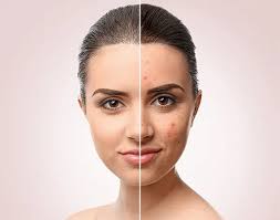 Acne Scars Treatment in Raipur
