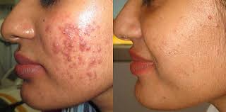 Acne Treatment Near Me in Raipur