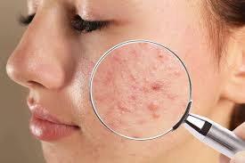 Acne Treatment in Raipur