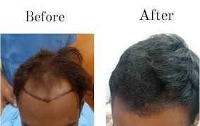 Affordable Hair Transplant Near Me in Raipur